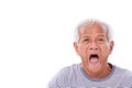 shocked, stunned, unhappy old man with surferÃ¢â¬â¢s eye or pterygium Royalty Free Stock Photo